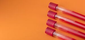 Read more about the article IgG 검사 – 정상 수치, 높을 때 낮을 때 원인, 식사 방법 및 면역 기능 평가