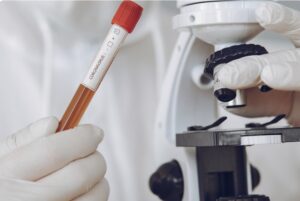 Read more about the article Microalbumin 검사 수치와 의미 – 신장 합병증 조기 진단법