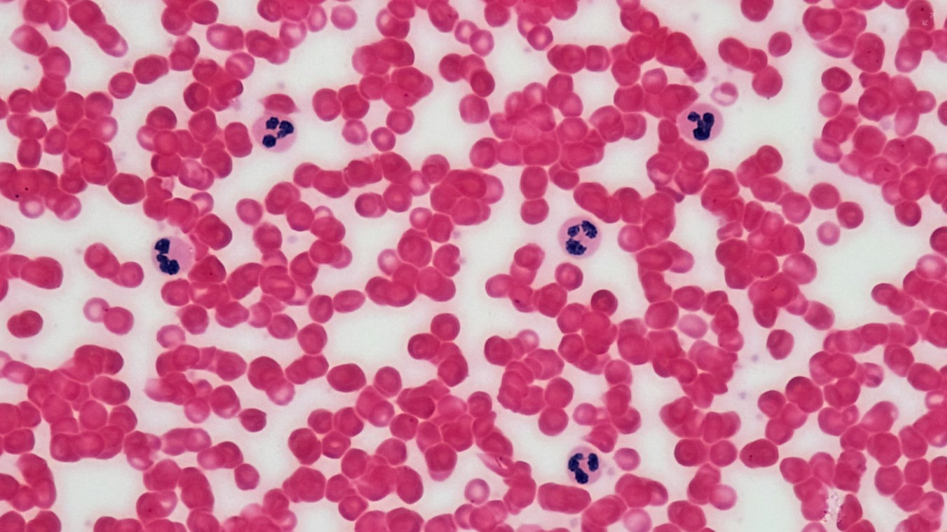 You are currently viewing Eosinophil(호산구) 수치 가이드 정상 범위와 호산구 증가증의 원인