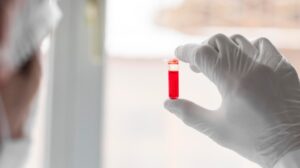 Read more about the article SCC Ag(편평세포암 항원) 검사 정상 수치와 암표지자의 의미