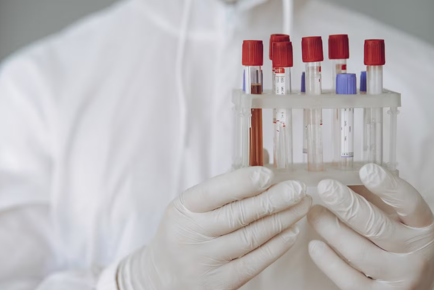 You are currently viewing Ketone body (케톤체) 3분획 검사 케토아시도시스(DKA) 및 유기산 대사 정밀 진단학적 접근