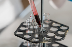 Read more about the article Anti-Jo-1 Ab (항 Jo-1 항체) 검사 자가면역성 다발성 근염 및 간질성 폐질환 정밀 해석